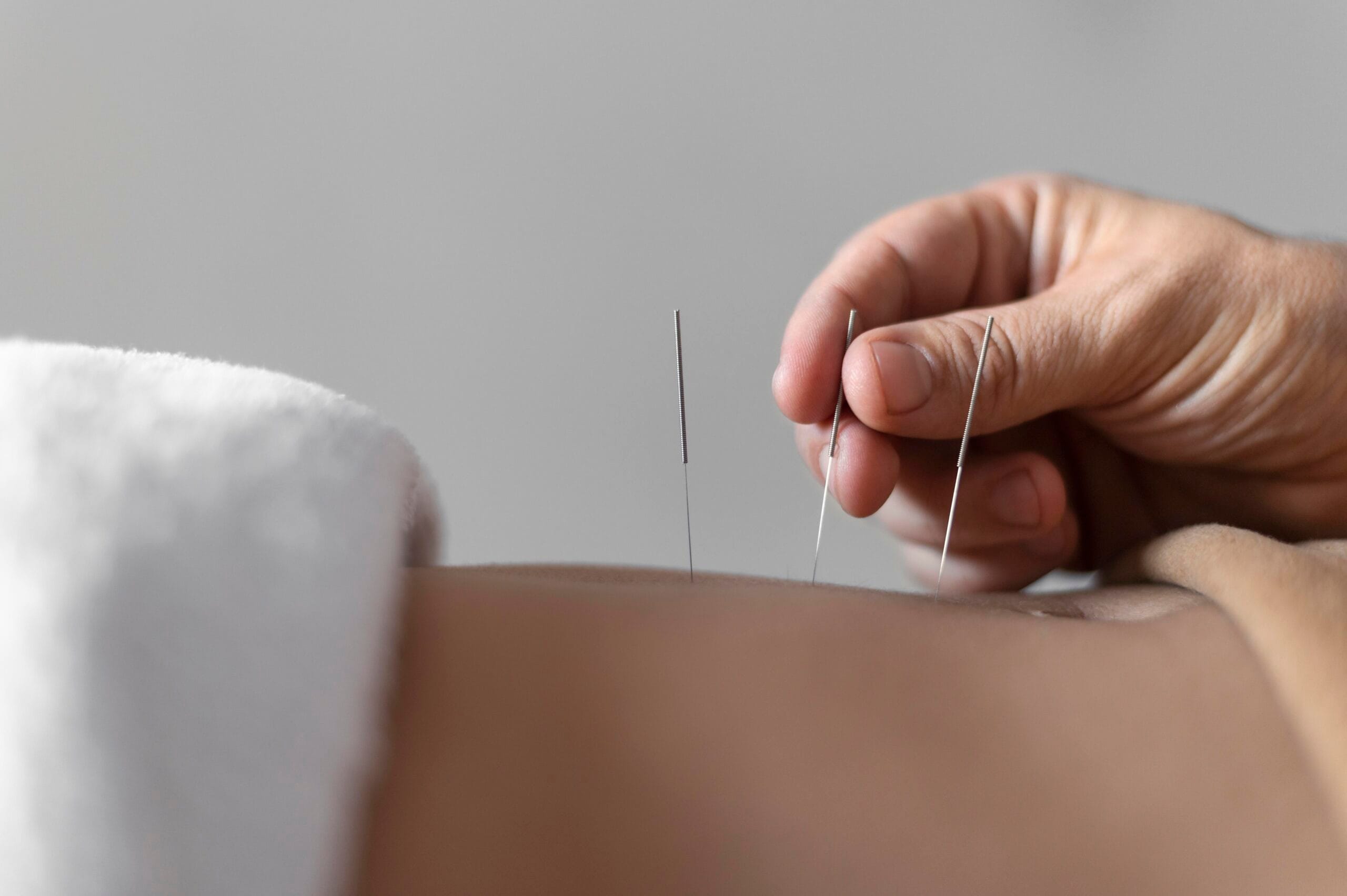 Hand placing acupuncture needles on skin